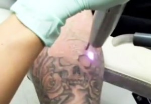 How Does Laser Tattoo Removal Work | Tattoo Removal Manchester.org