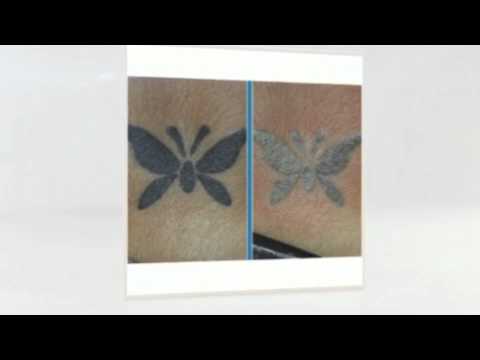 How Does Laser Tattoo Removal Work | Tattoo Removal Manchester.org