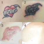 Rejuvi-Tatoo-Removal